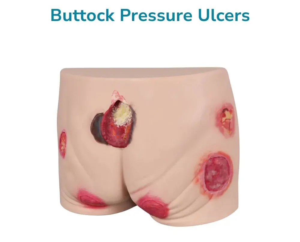 Buttock Pressure Ulcer Model