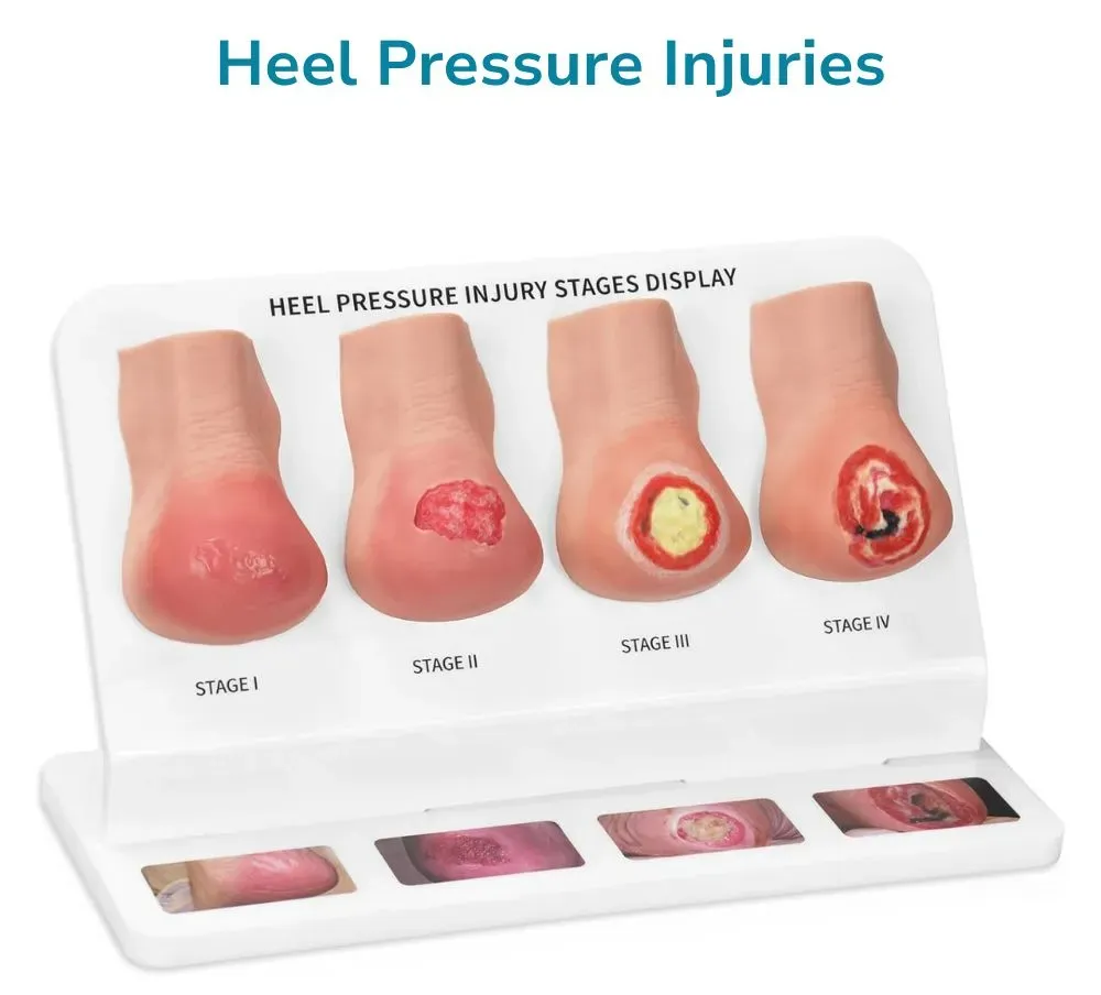 heel pressure injury model