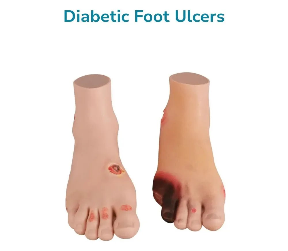Diabetic Foot Model with Pressure Ulcer
