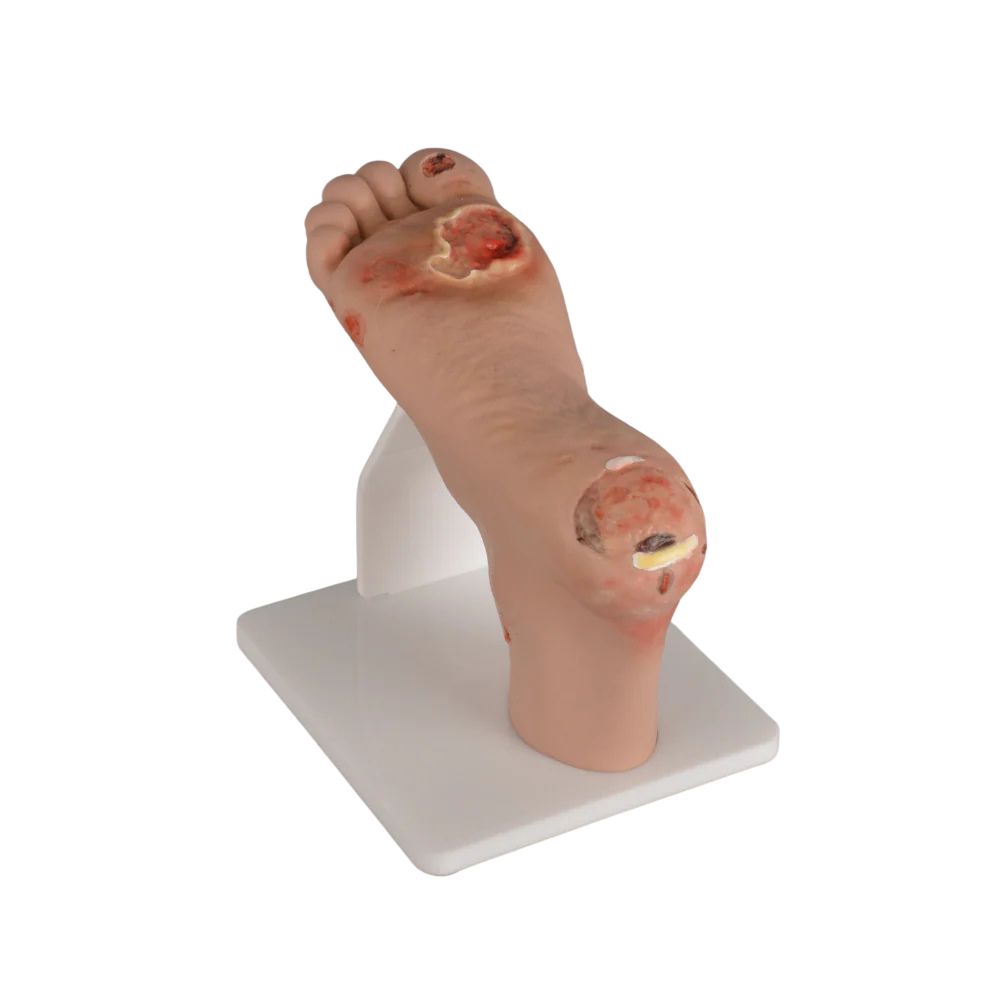 Full-Foot Diabetic Foot Ulcer Model – Mild & Severe Stages