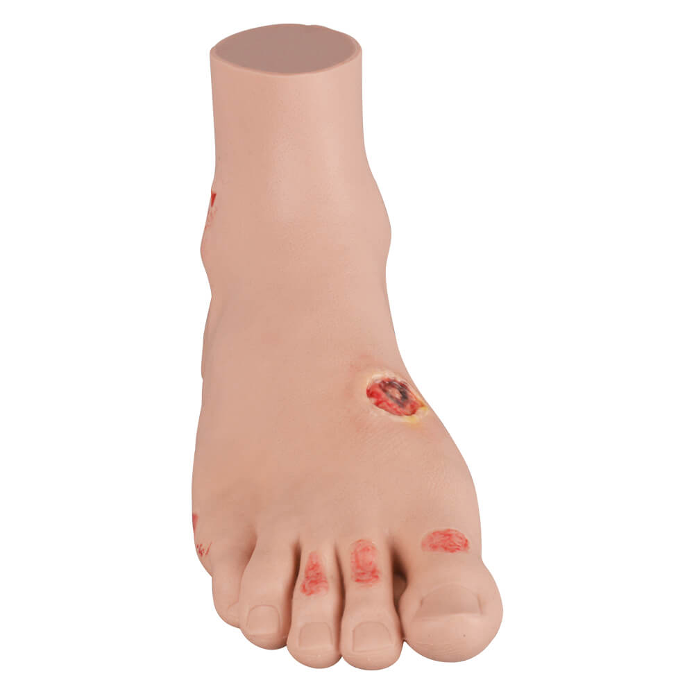 Full-Foot Diabetic Foot Ulcer Model – Mild & Severe Stages