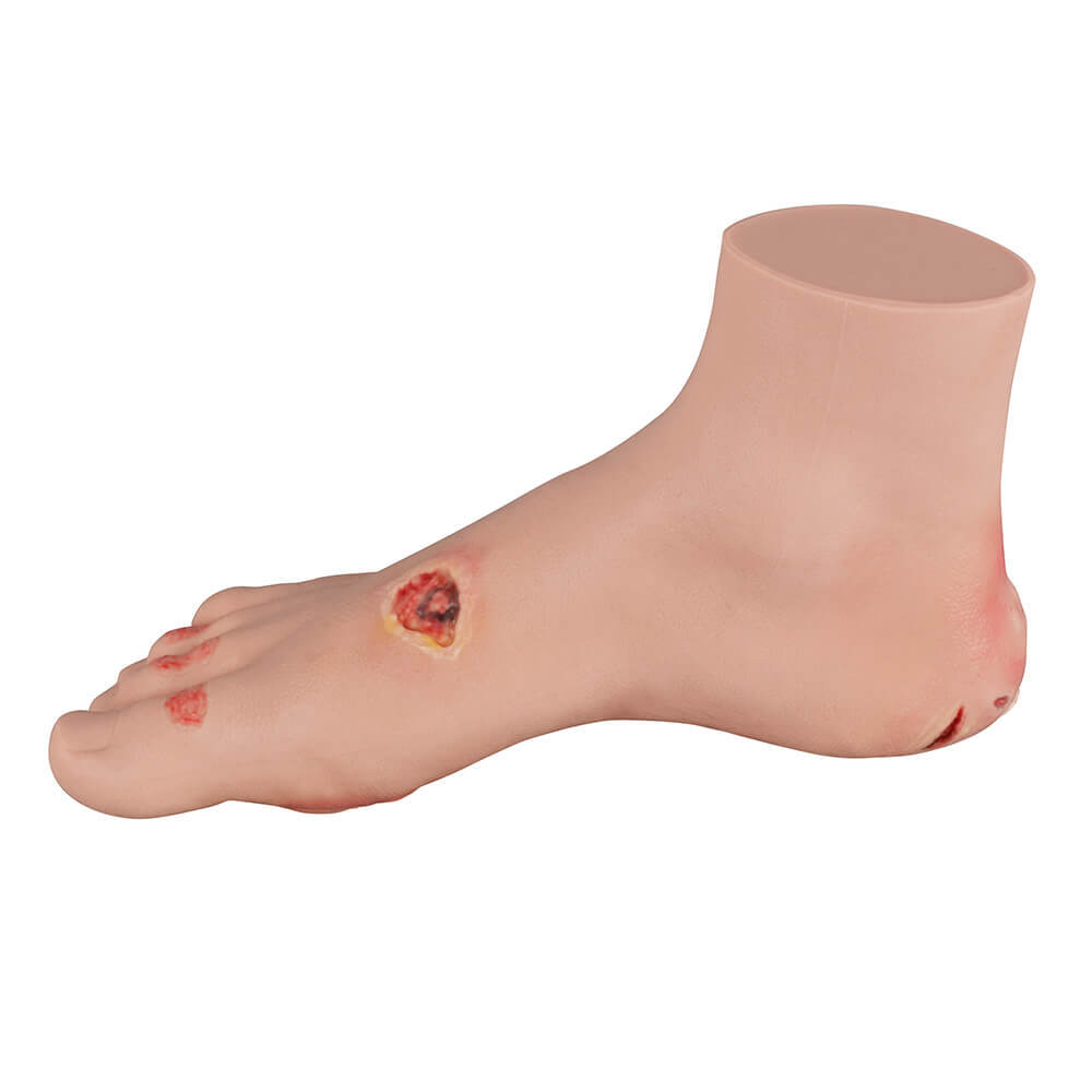 Full-Foot Diabetic Foot Ulcer Model – Mild & Severe Stages