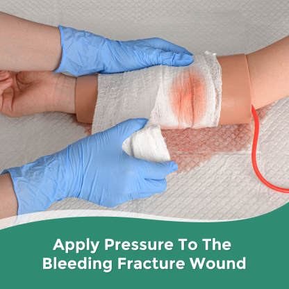 Open Fracture Wound Hand Sleeve Kit with Bleeding Function