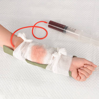 Open Fracture Wound Hand Sleeve Kit with Bleeding Function