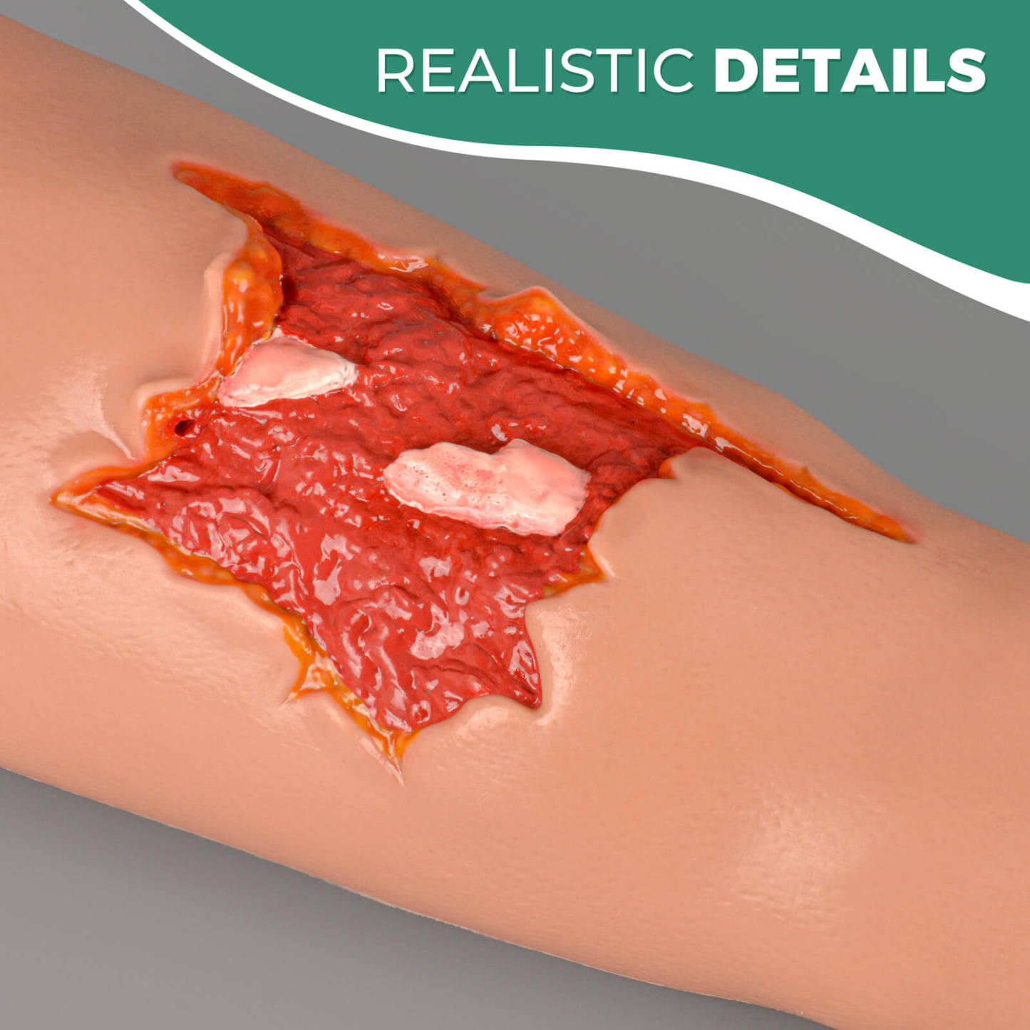 Open Fracture Wound Hand Sleeve Kit with Bleeding Function