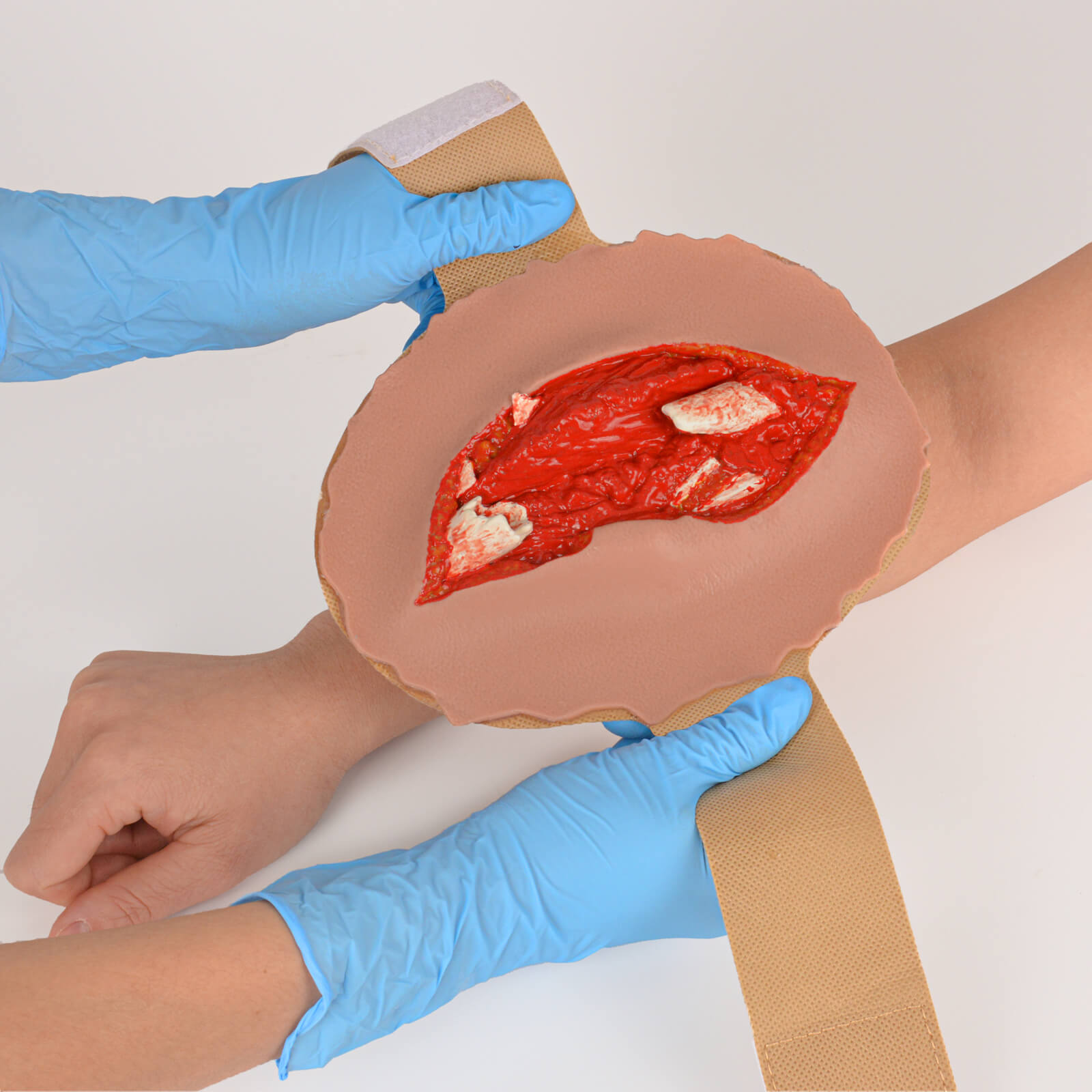 Open Fracture Wound Moulage, Grade 2-5