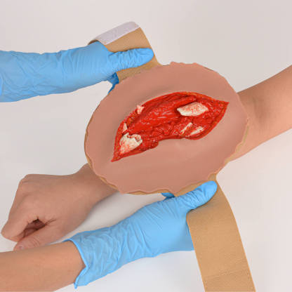 Open Fracture Wound Moulage, Grade 2-5