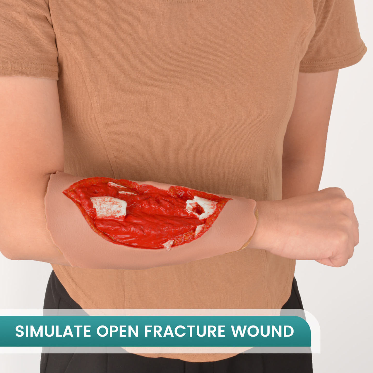 Open Fracture Wound Moulage, Grade 2-5