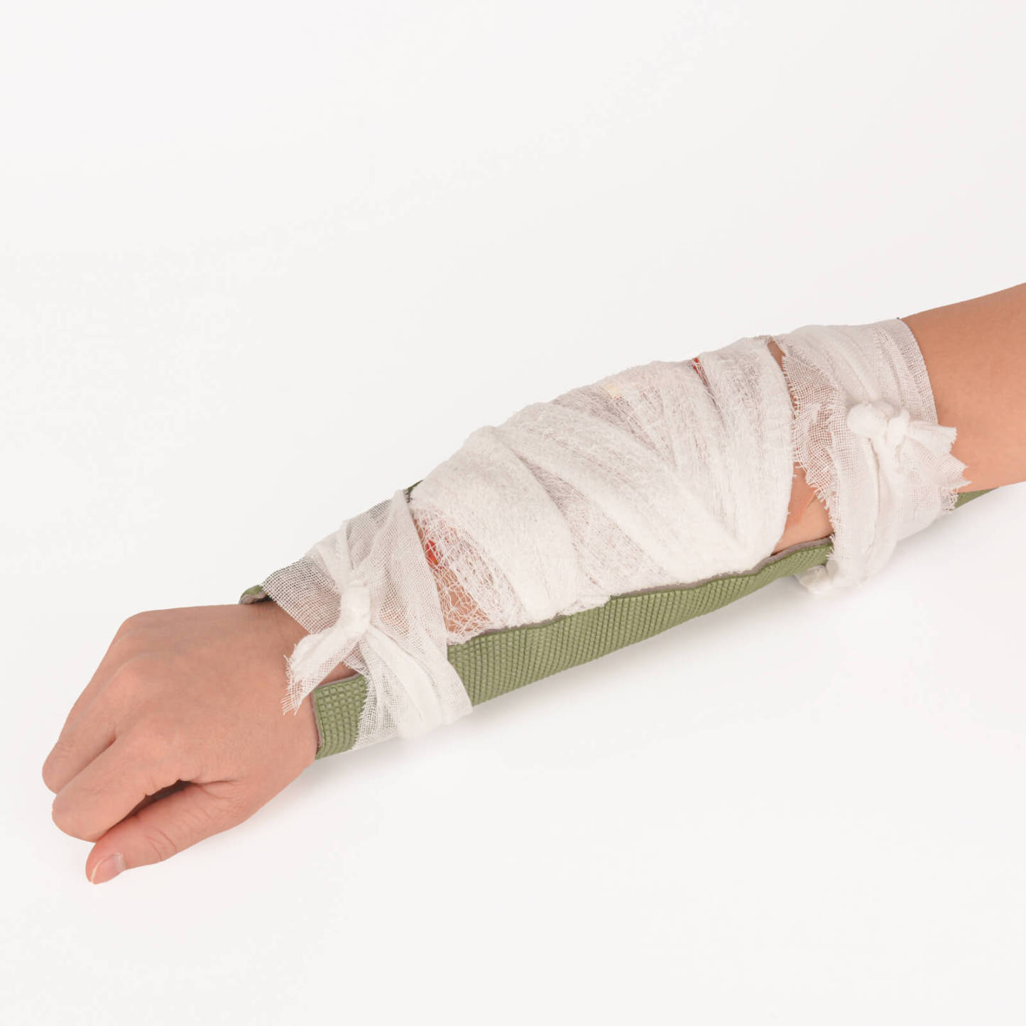 Open Fracture Wound Moulage, Grade 2-5