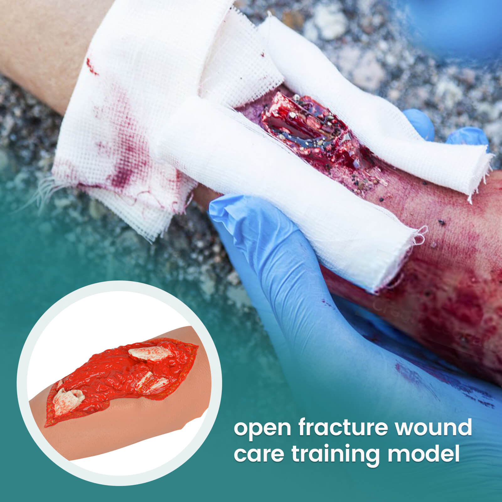 Open Fracture Wound Moulage, Grade 2-5