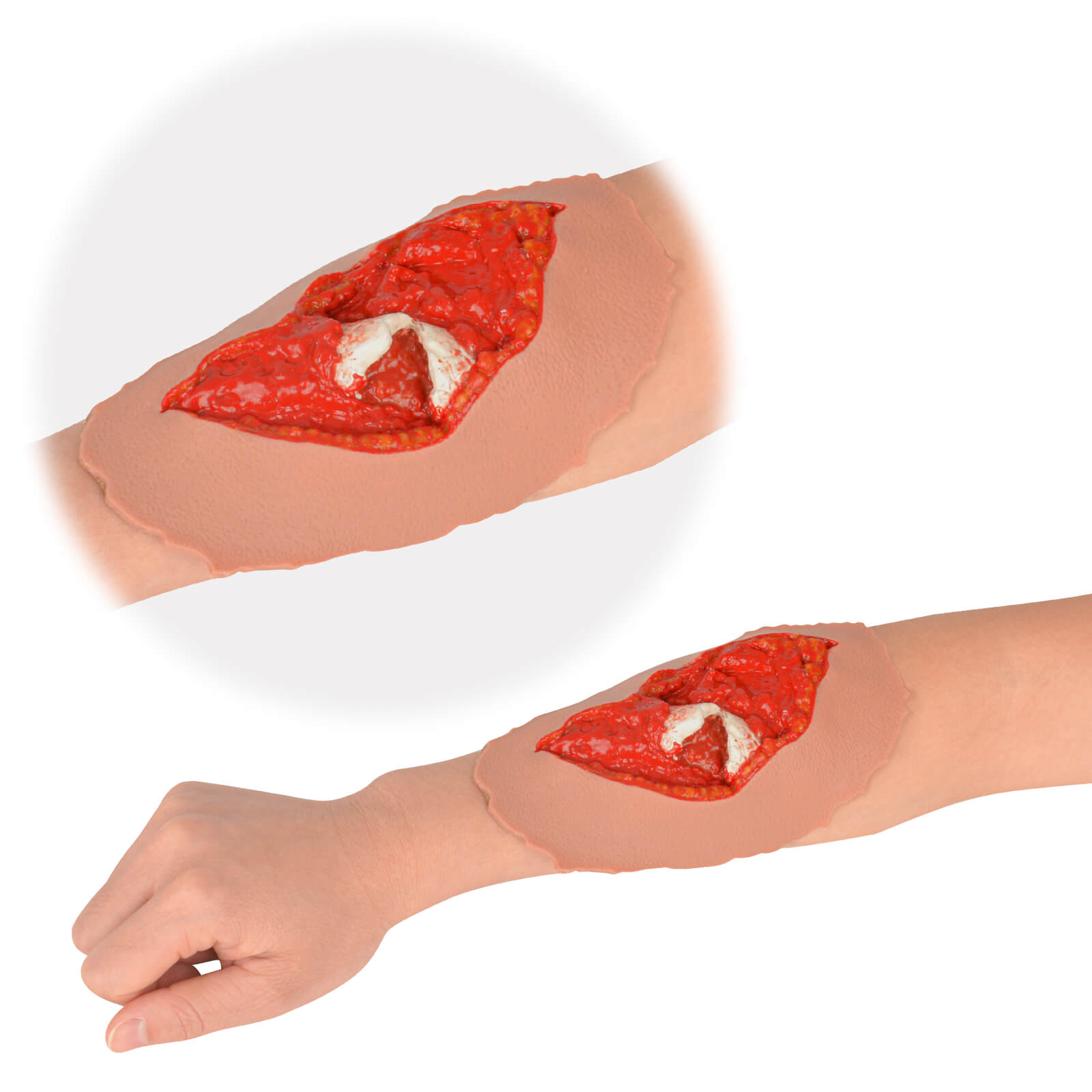 Open Fracture Wound Moulage, Grade 2-5