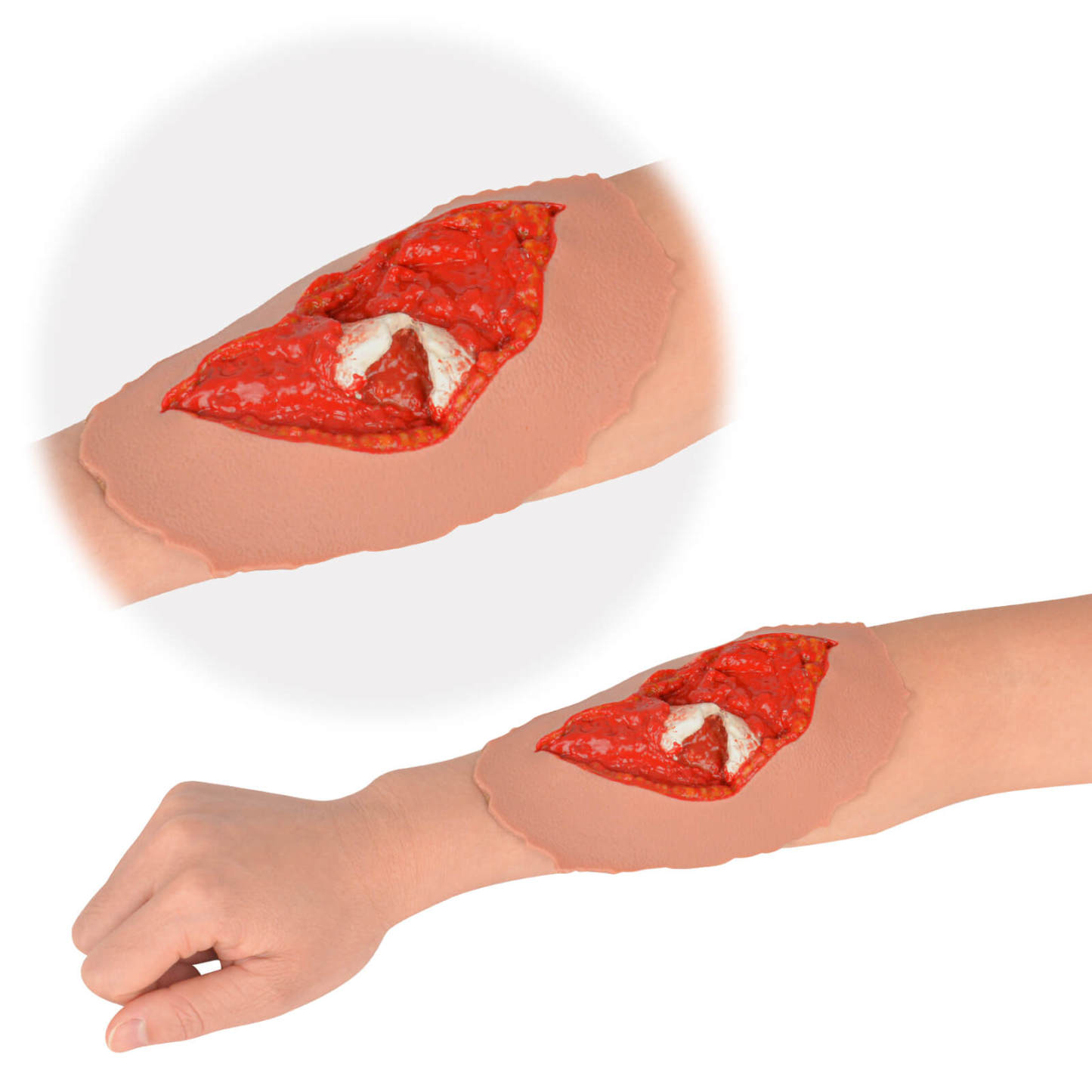 Open Fracture Wound Moulage, Grade 2-5