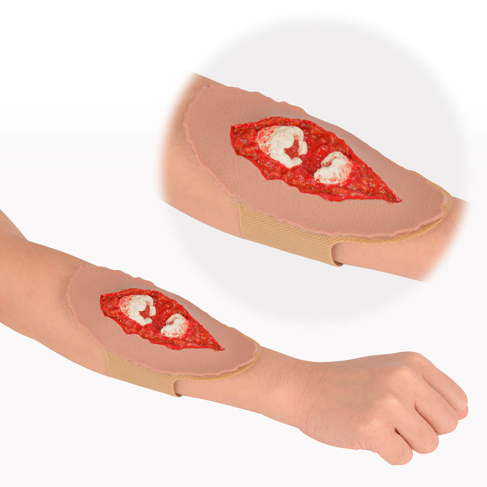 Open Fracture Wound Moulage, Grade 2-5