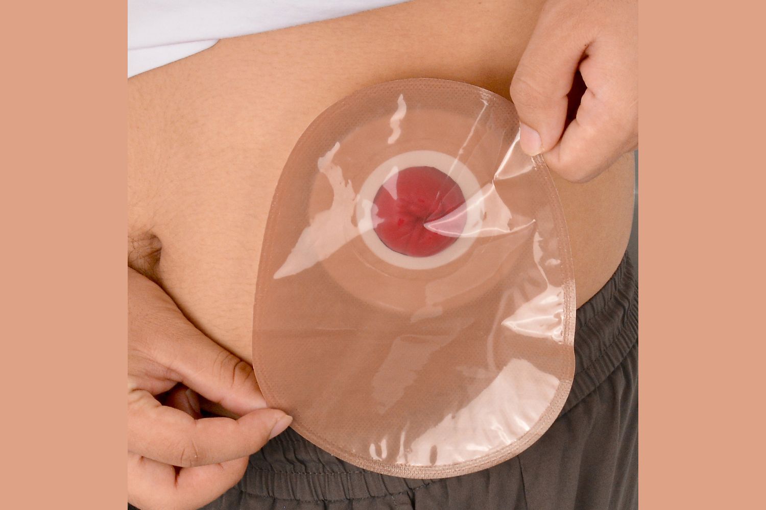 Ostomy Pouch Application Step by Step Guide
