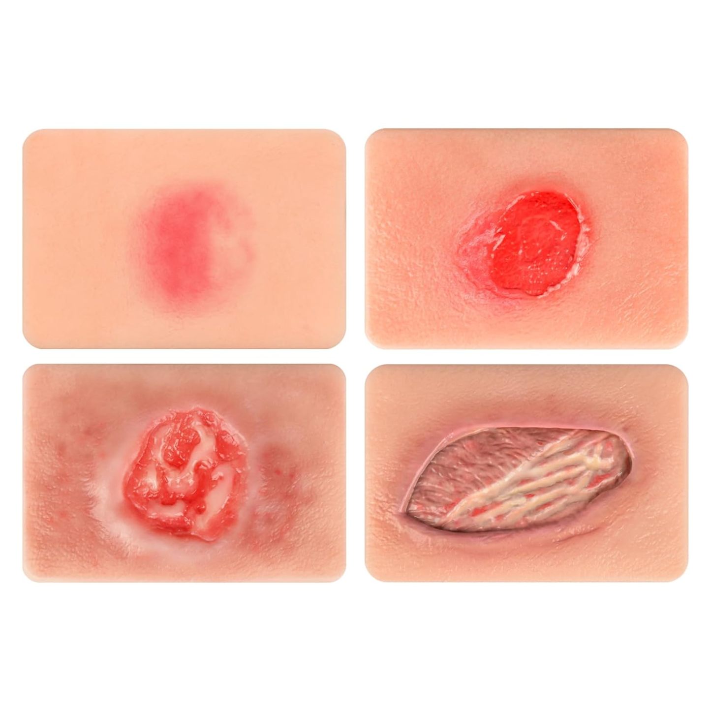 Handheld Pressure Ulcer Wound Simulation Models (Stage 1-4)