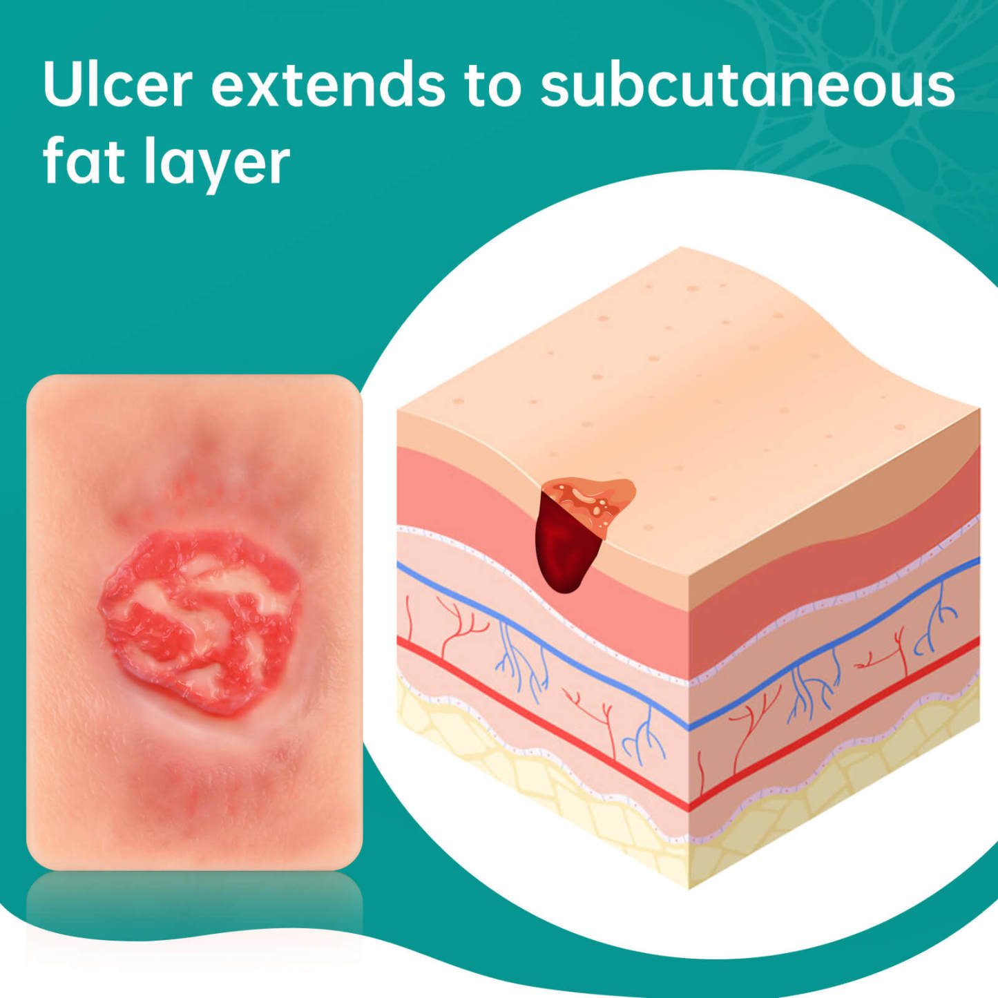 Card-Sized Pressure Ulcer Wound Models (Stage 2, 3, 4)