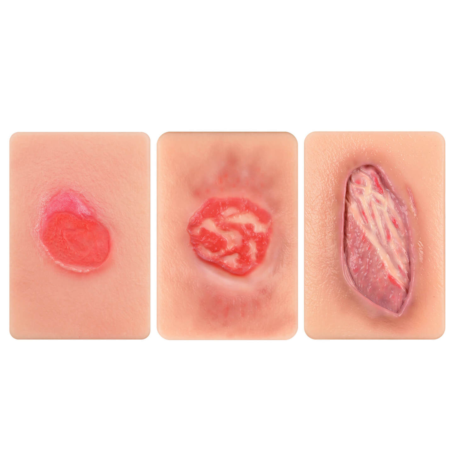 Card-Sized Pressure Ulcer Wound Models (Stage 2, 3, 4)