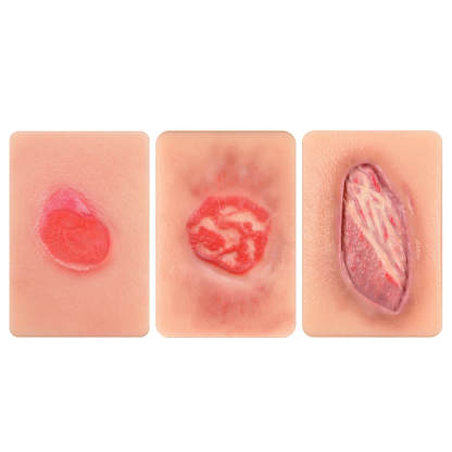Card-Sized Pressure Ulcer Wound Models (Stage 2, 3, 4)