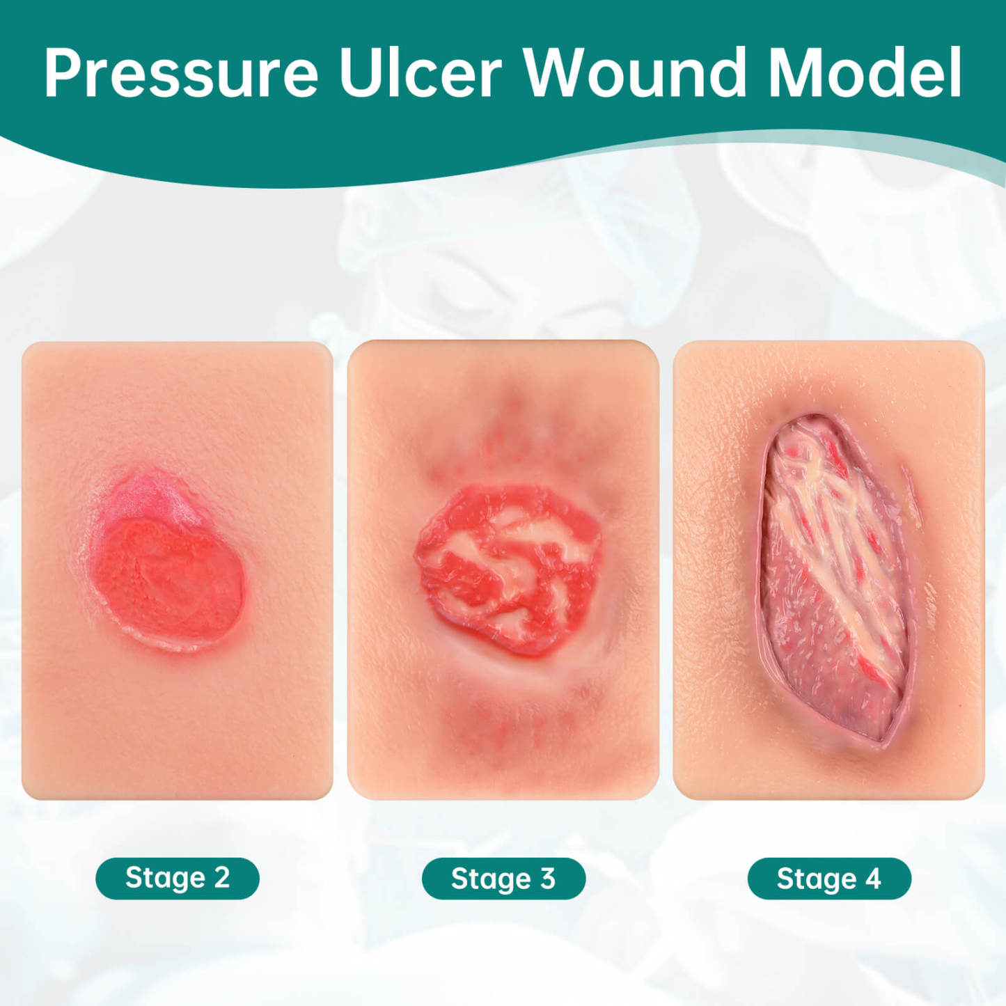 Card-Sized Pressure Ulcer Wound Models (Stage 2, 3, 4)