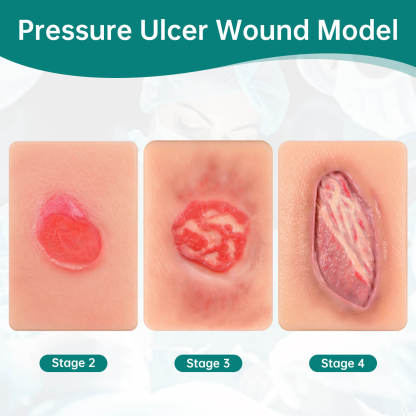 Card-Sized Pressure Ulcer Wound Models (Stage 2, 3, 4)