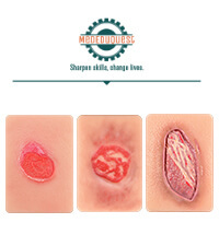 Card-Sized Pressure Ulcer Wound Models (Stage 2, 3, 4)