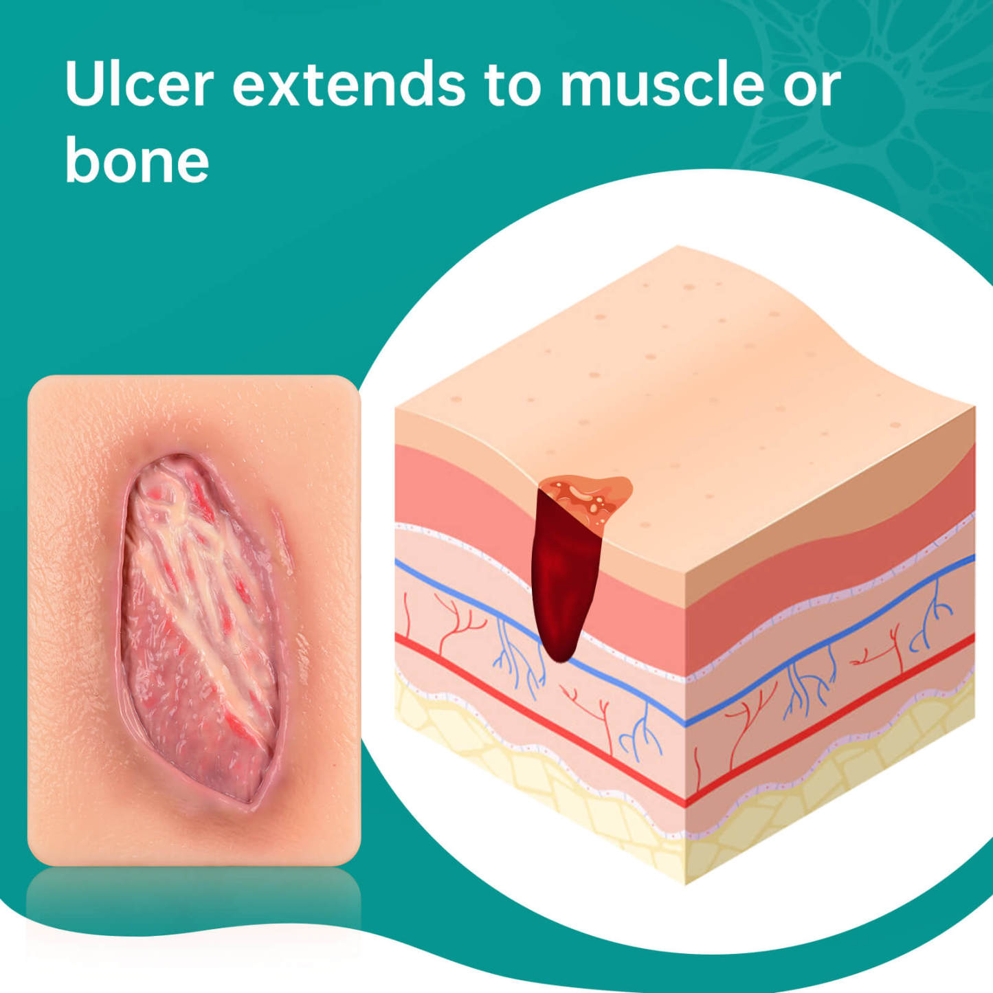 Card-Sized Pressure Ulcer Wound Models (Stage 2, 3, 4)
