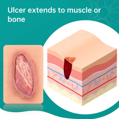 Card-Sized Pressure Ulcer Wound Models (Stage 2, 3, 4)