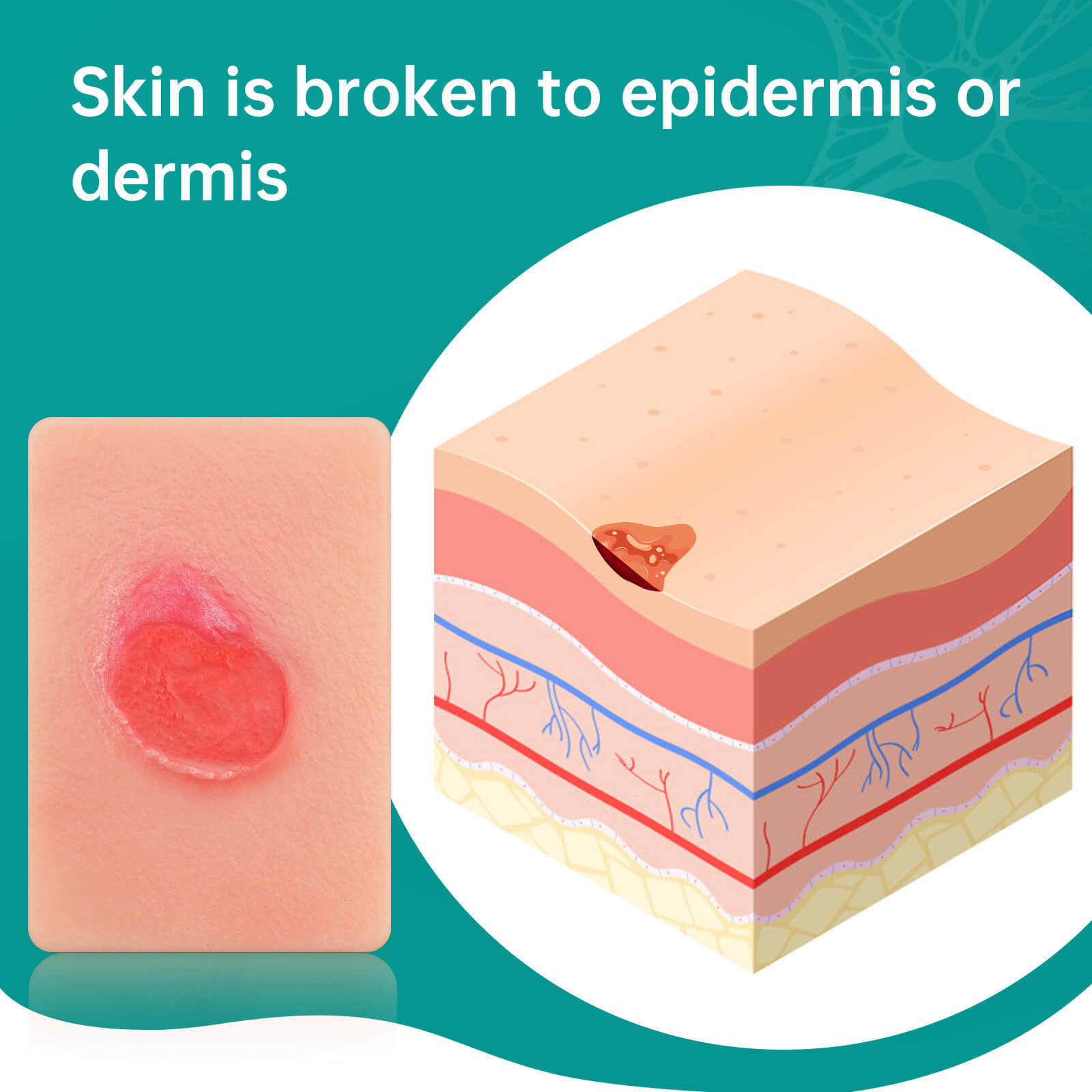 Card-Sized Pressure Ulcer Wound Models (Stage 2, 3, 4)
