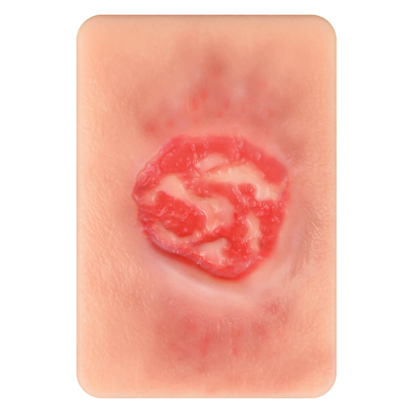 Card-Sized Pressure Ulcer Wound Models (Stage 2, 3, 4)