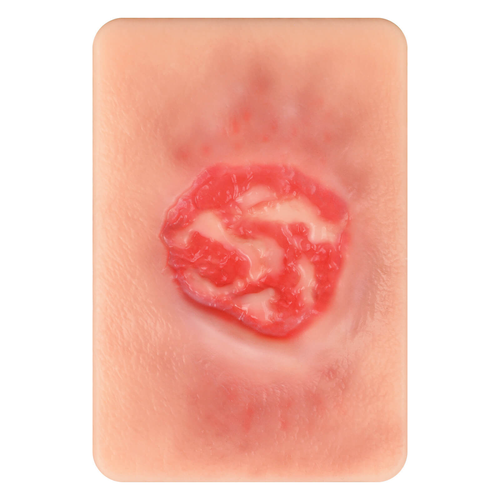 Card-Sized Pressure Ulcer Wound Models (Stage 2, 3, 4)