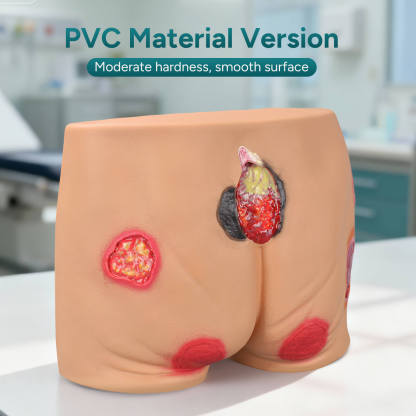 PVC Buttock Decubitus Ulcer Model with Multi-Stage Ulcer Simulation