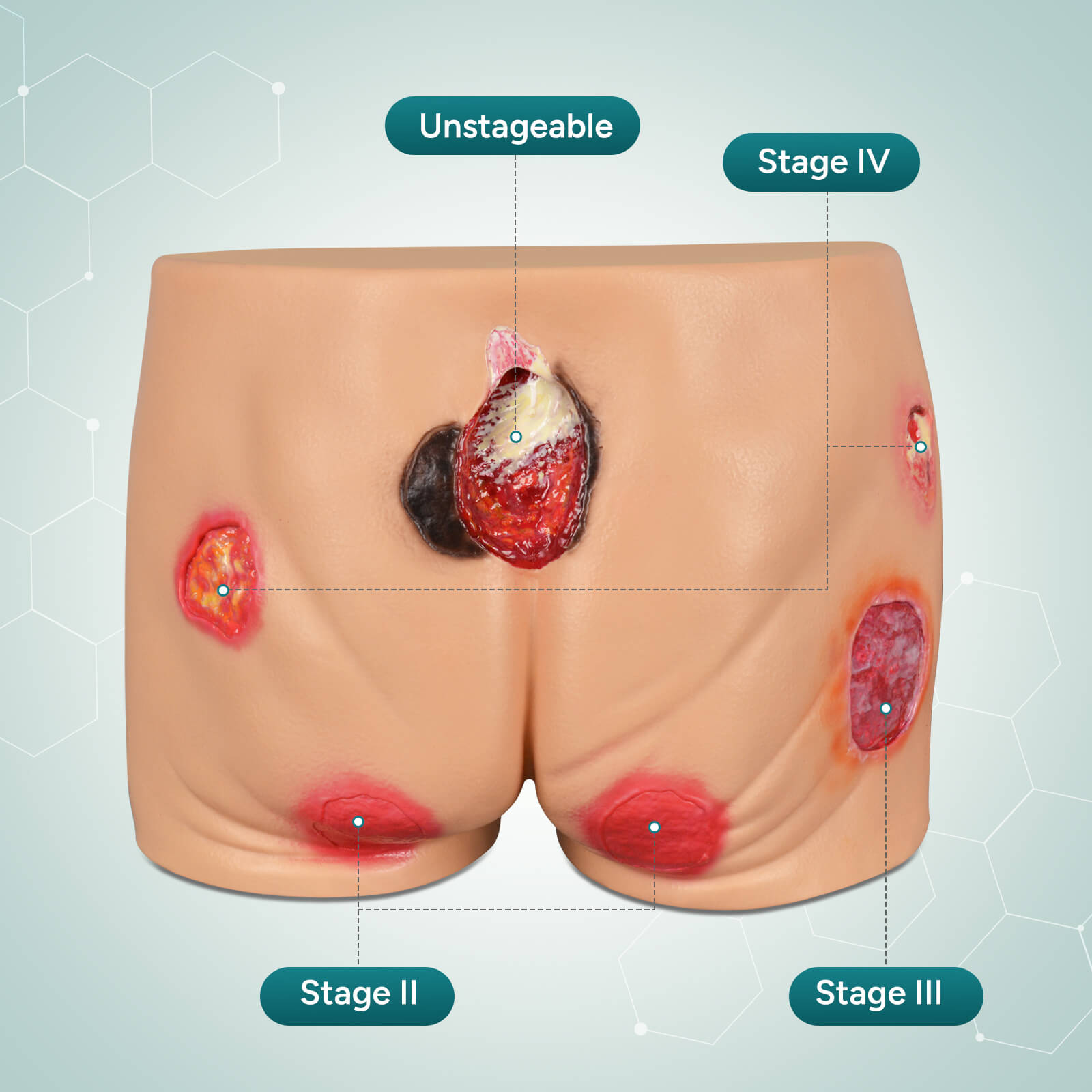 PVC Buttock Decubitus Ulcer Model with Multi-Stage Ulcer Simulation