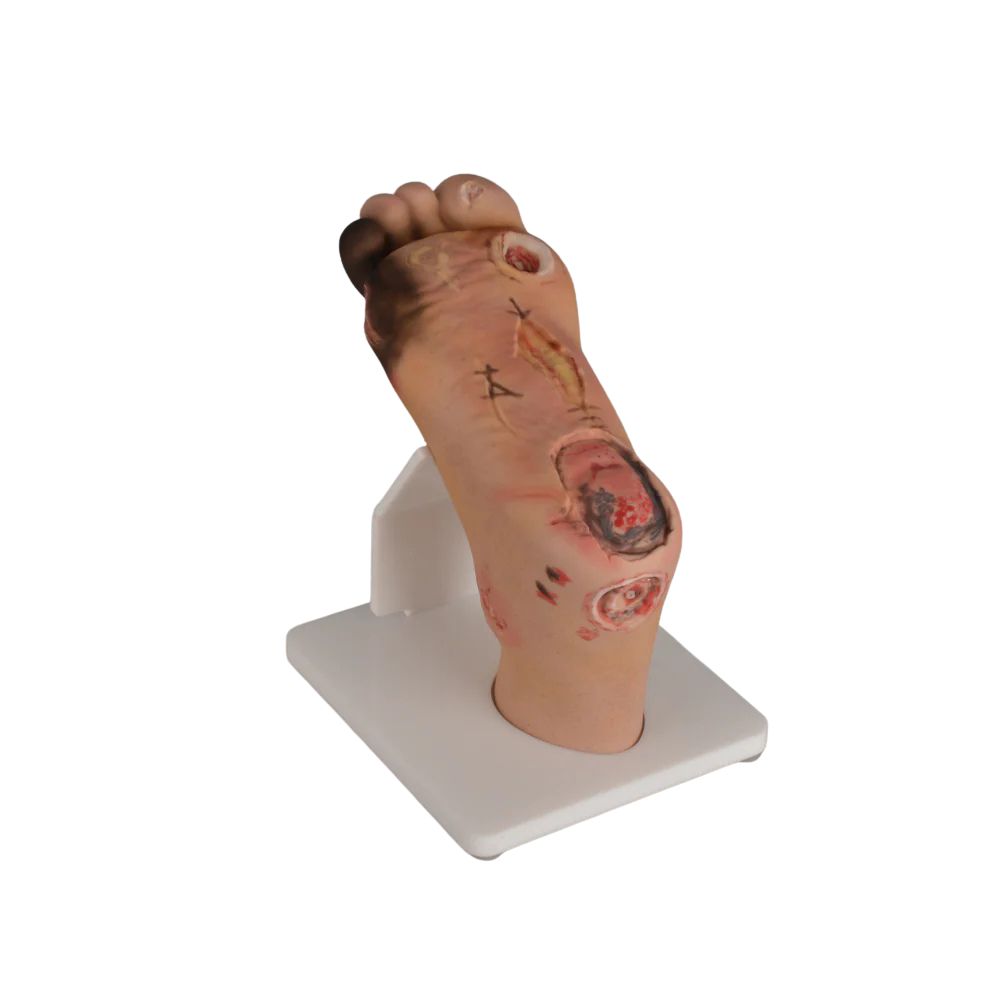 Full-Foot Diabetic Foot Ulcer Model – Mild & Severe Stages