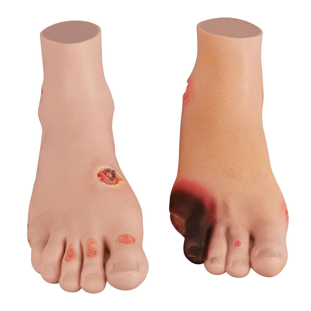 Full-Foot Diabetic Foot Ulcer Model – Mild & Severe Stages