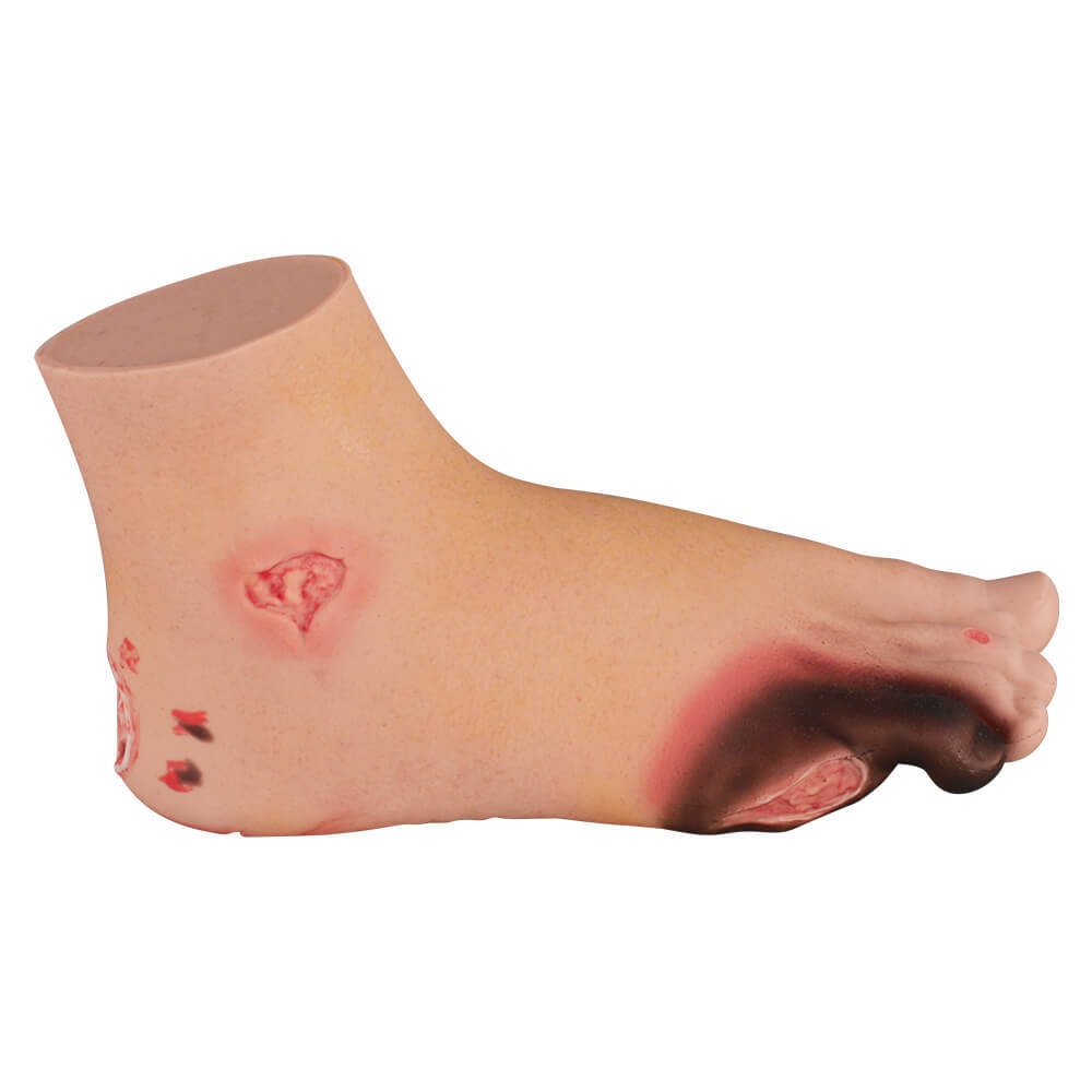 Full-Foot Diabetic Foot Ulcer Model – Mild & Severe Stages