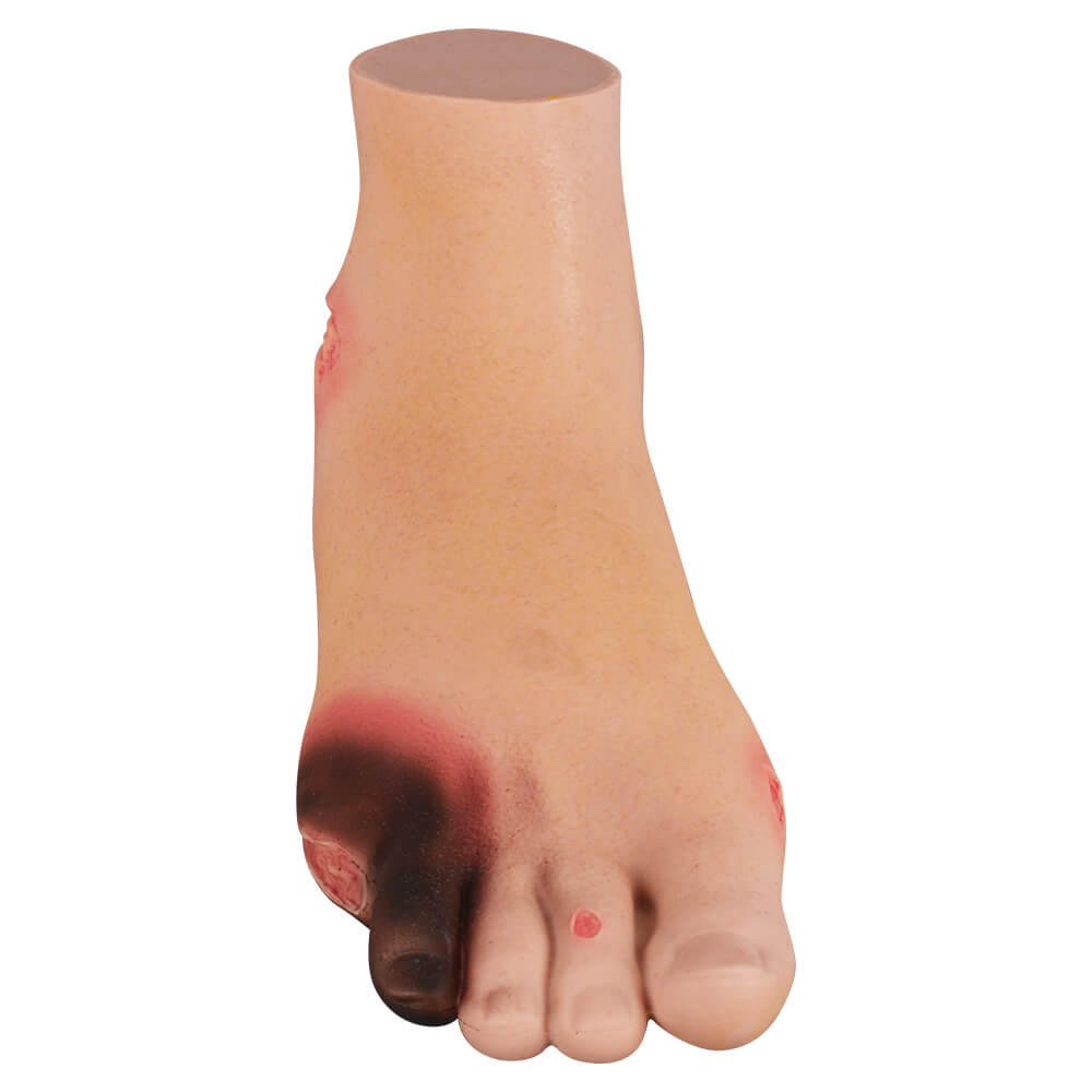 Full-Foot Diabetic Foot Ulcer Model – Mild & Severe Stages
