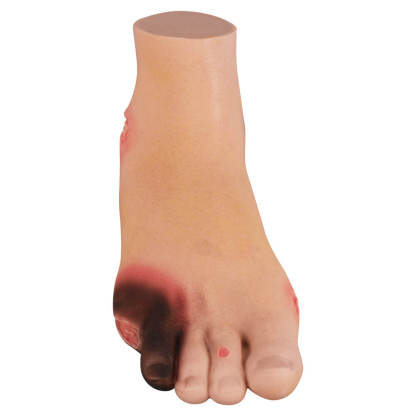 Full-Foot Diabetic Foot Ulcer Model – Mild & Severe Stages