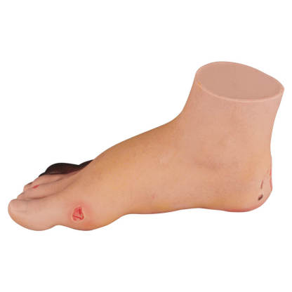 Full-Foot Diabetic Foot Ulcer Model – Mild & Severe Stages