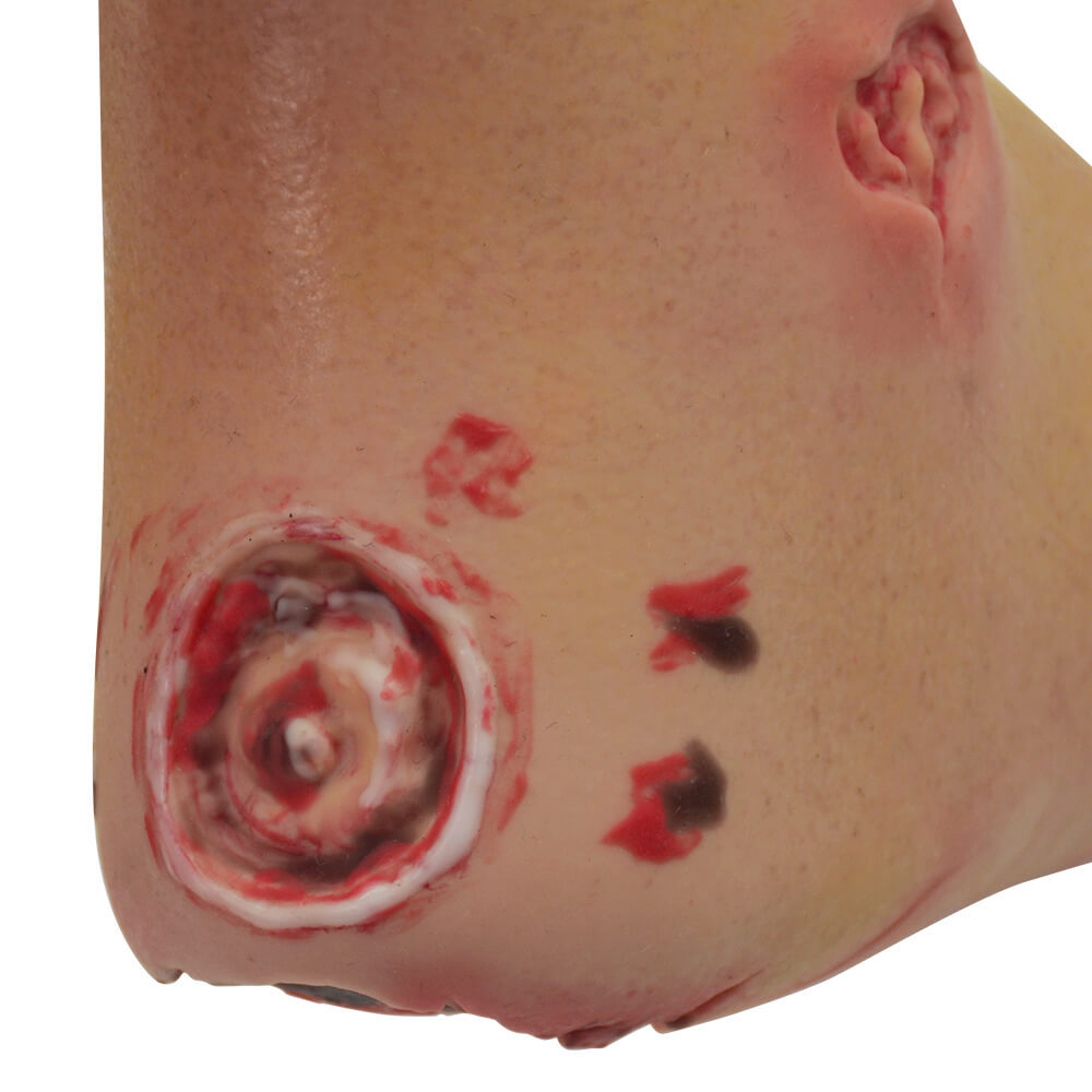 Full-Foot Diabetic Foot Ulcer Model – Mild & Severe Stages