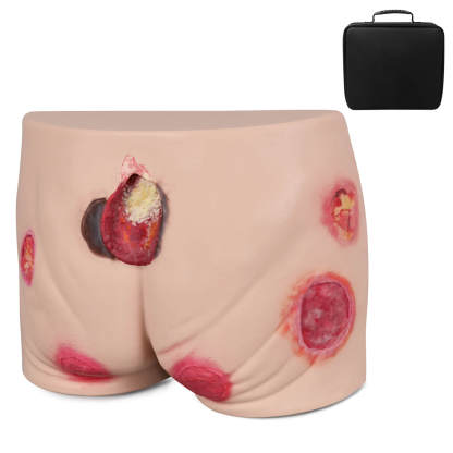Silicone Buttock Pressure Ulcer Model with Multi-Stage Ulcer Simulation