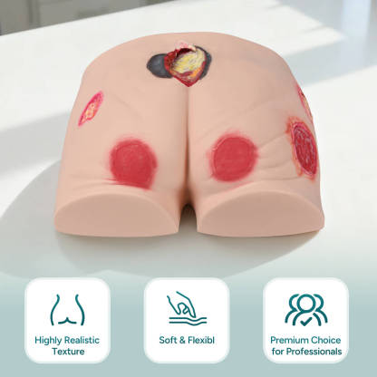Silicone Buttock Pressure Ulcer Model with Multi-Stage Ulcer Simulation