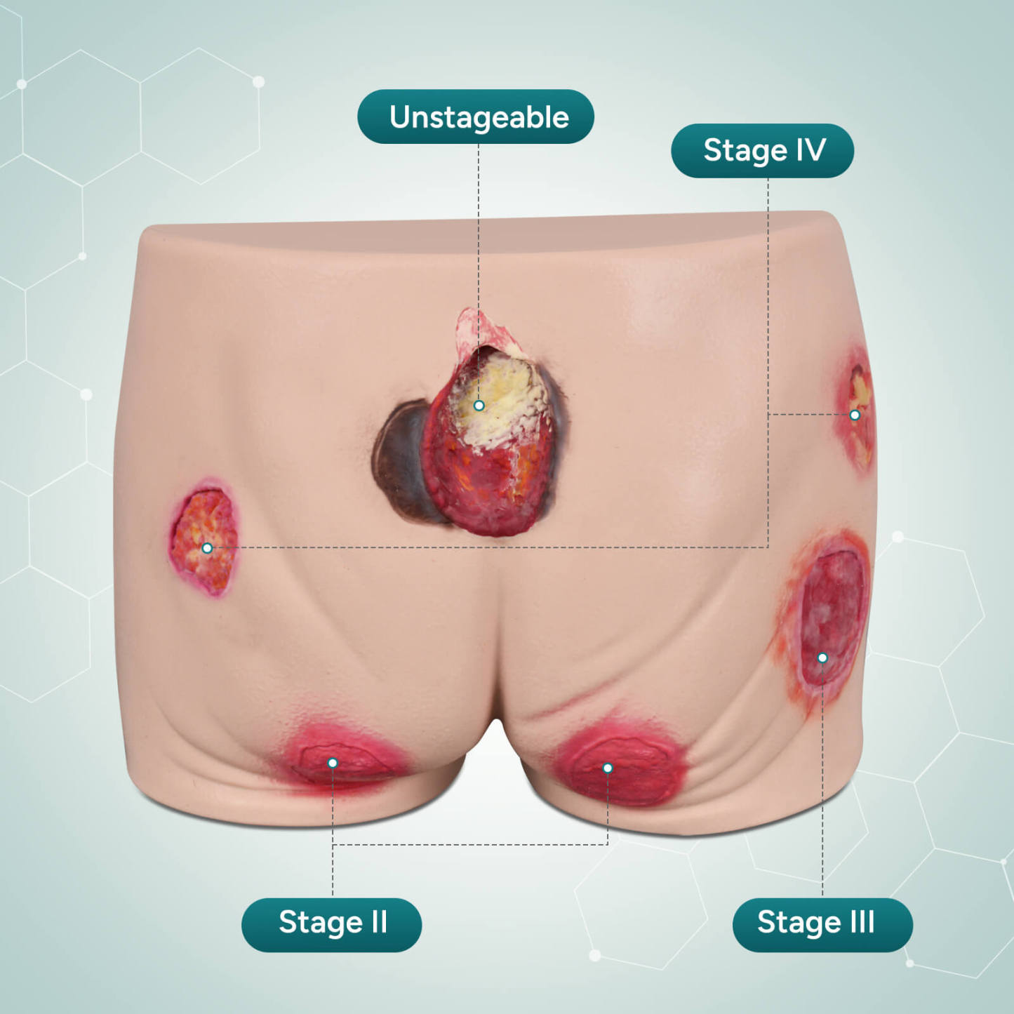 Silicone Buttock Pressure Ulcer Model with Multi-Stage Ulcer Simulation