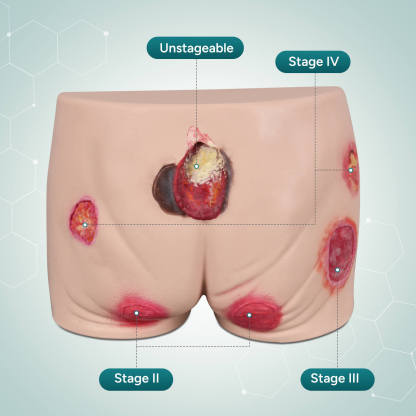 Silicone Buttock Pressure Ulcer Model with Multi-Stage Ulcer Simulation