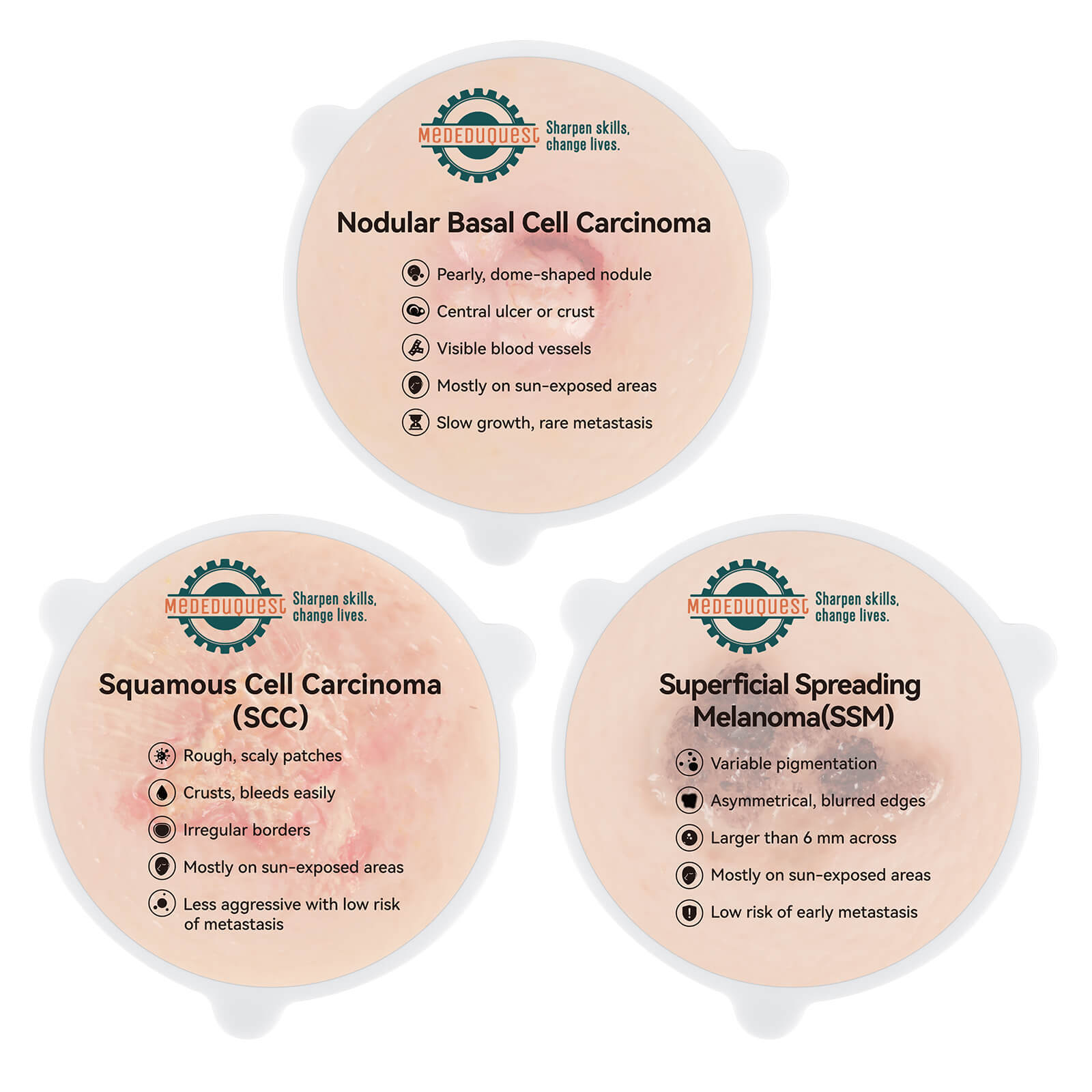 Skin Cancer Model for Medical & Dermatology Training