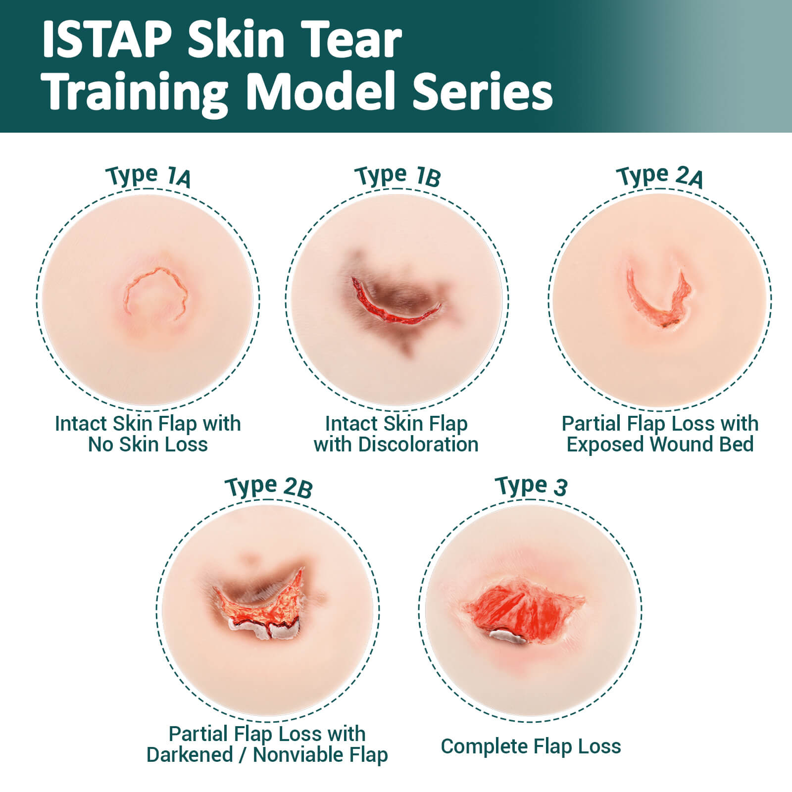 Adhesive Skin Tear Wound Moulage