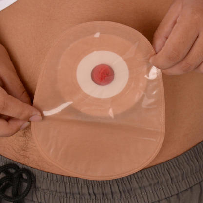 Sticky Ileostomy Stoma Training Models, Tan Skin