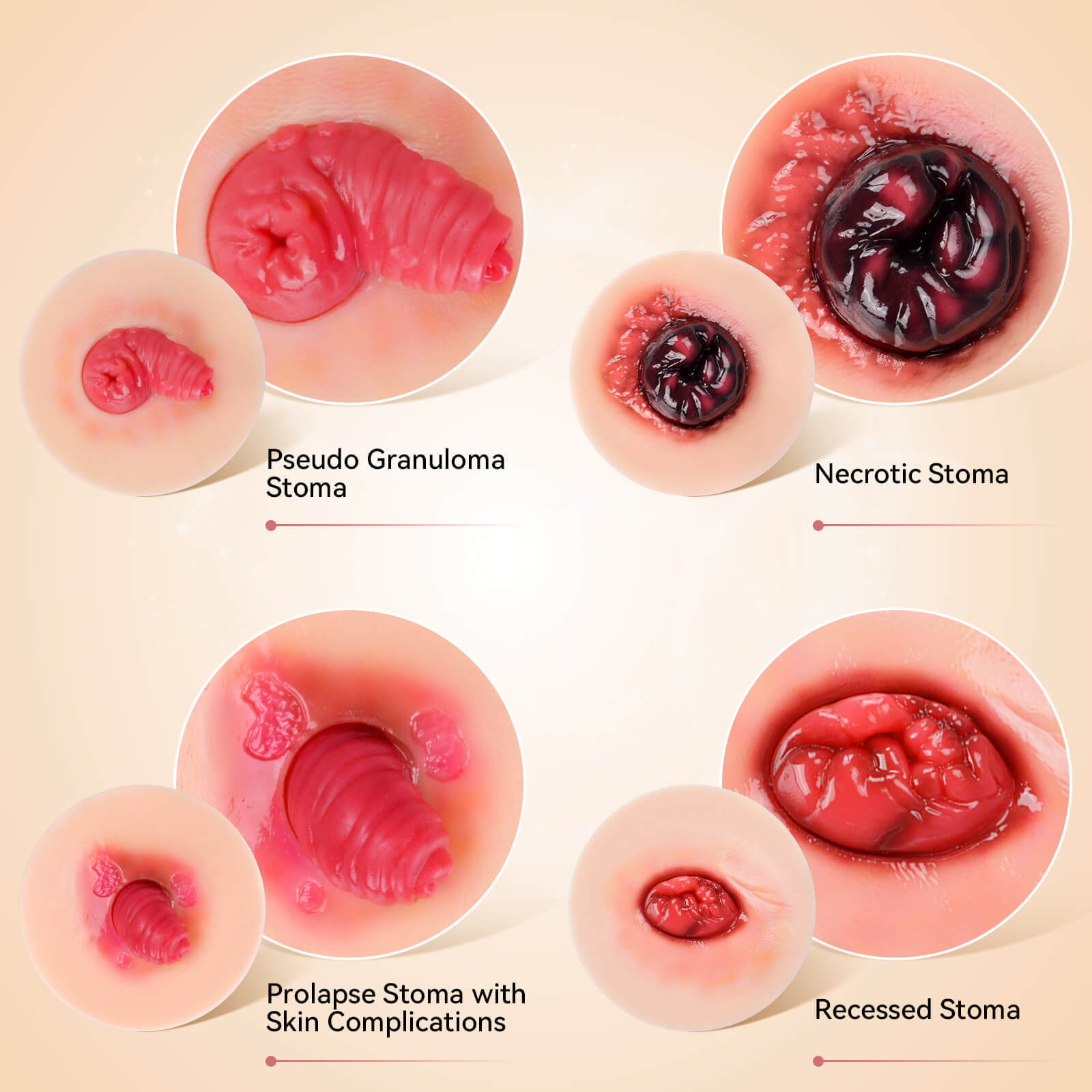 Sticky Stoma Complications Simulation Models Set