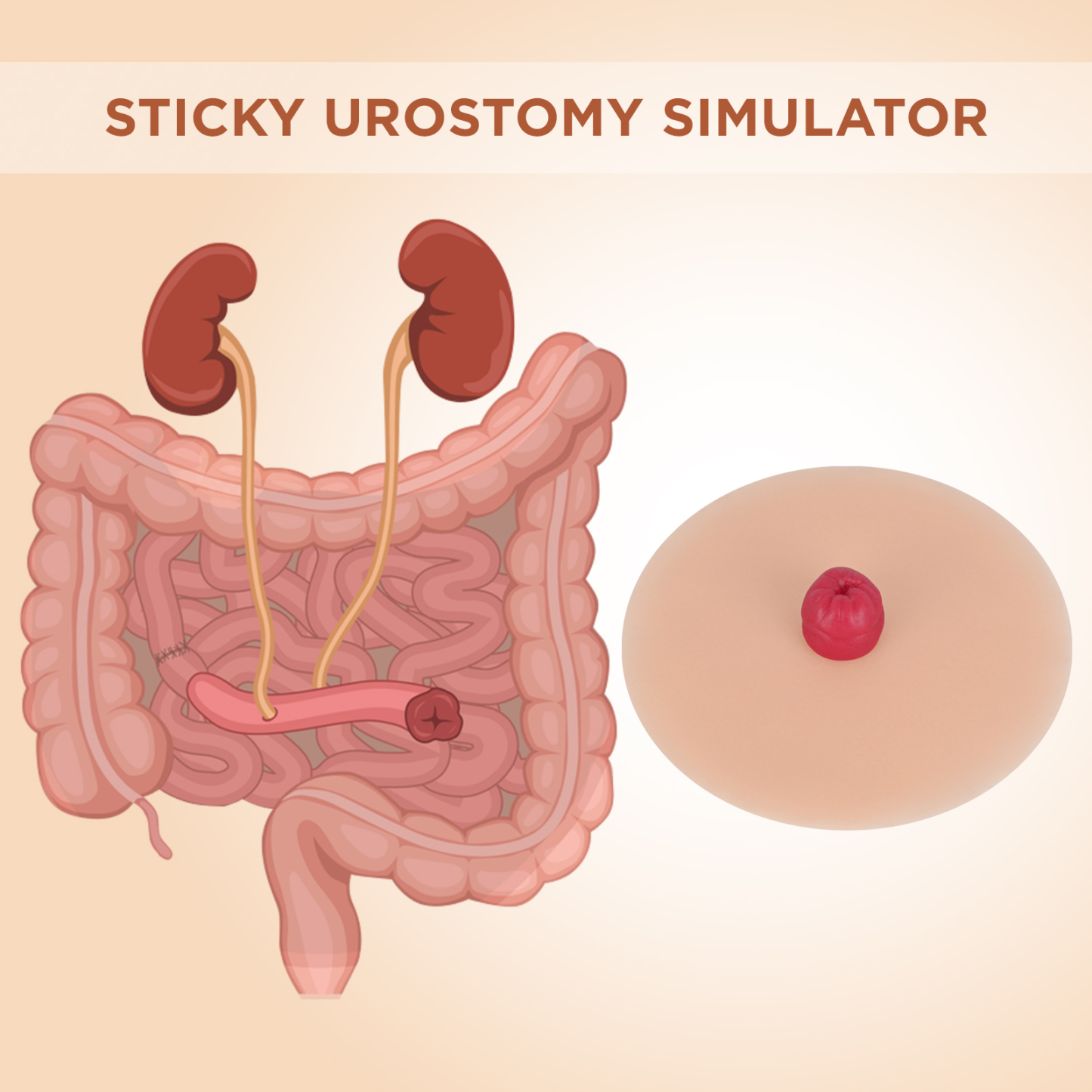 Sticky Urostomy Stoma Care Training Kit, Light Skin