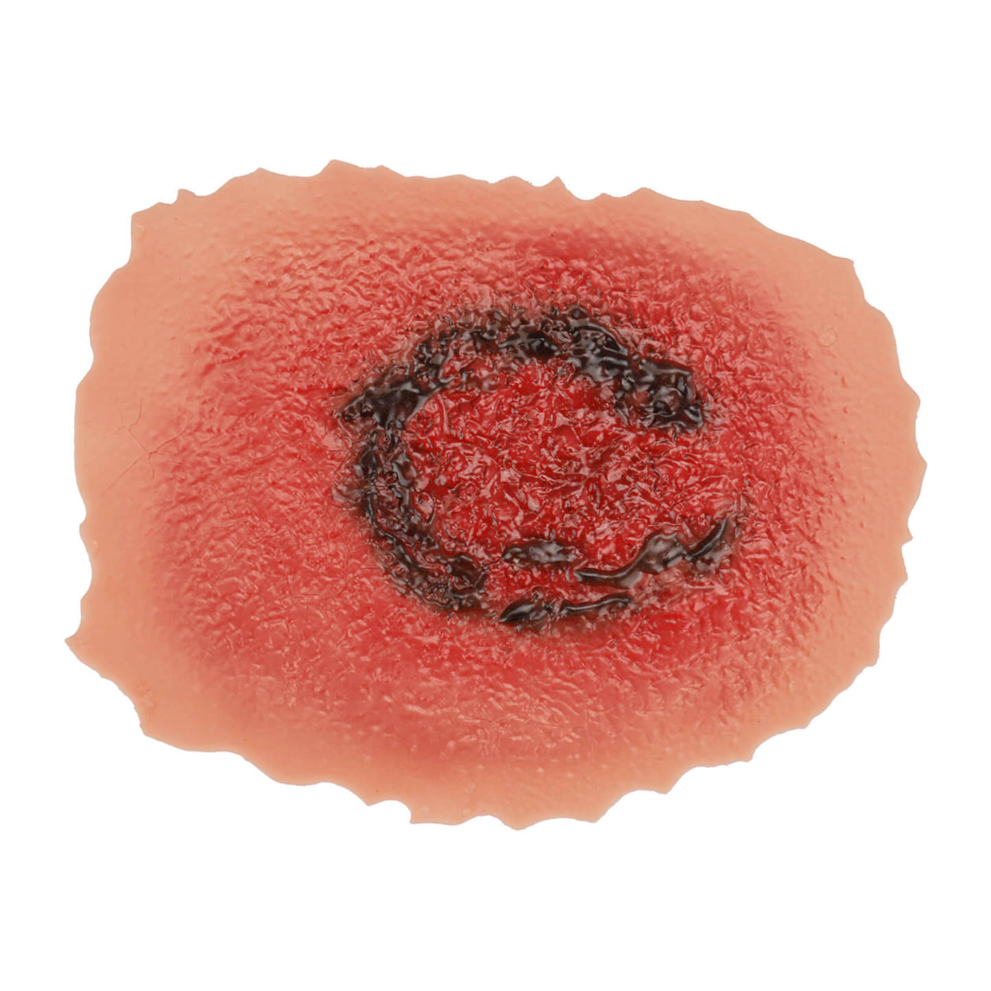 3rd Degree Skin Burn Wound Model