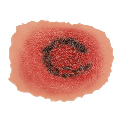 3rd Degree Skin Burn Wound Model